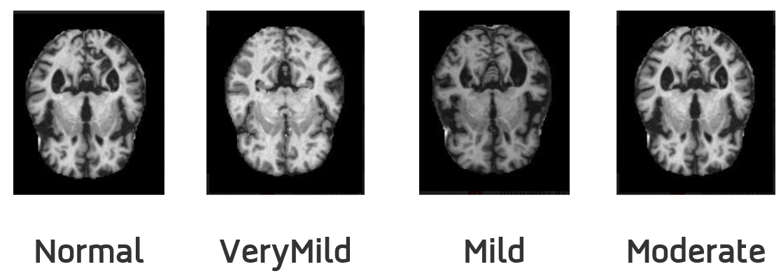 Machine Learning for Alzheimer's Detection from MRI Images