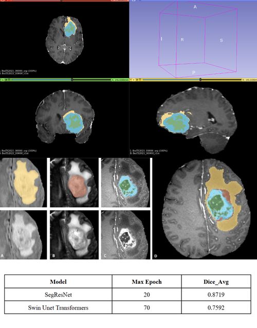 Brain Tumor Segmentation using SegResNet