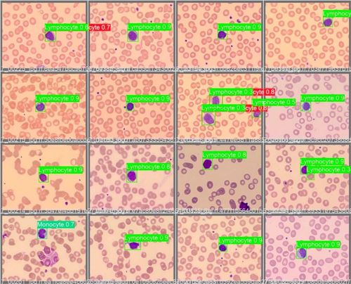 Object Detection in White Blood Cells for Leukemia