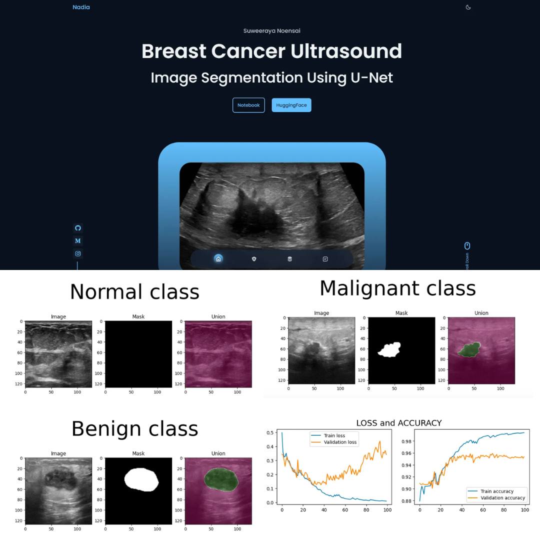 Breast Cancer Ultrasound Image Segmentation Using U-Net