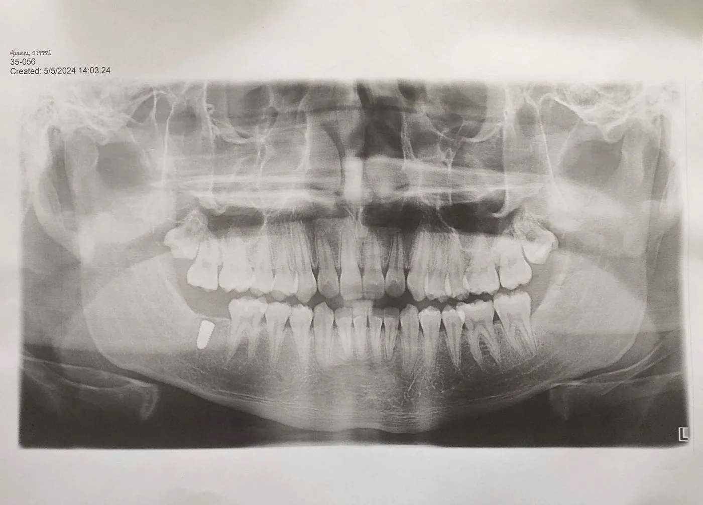 Teeth segmentation using Res-UNet