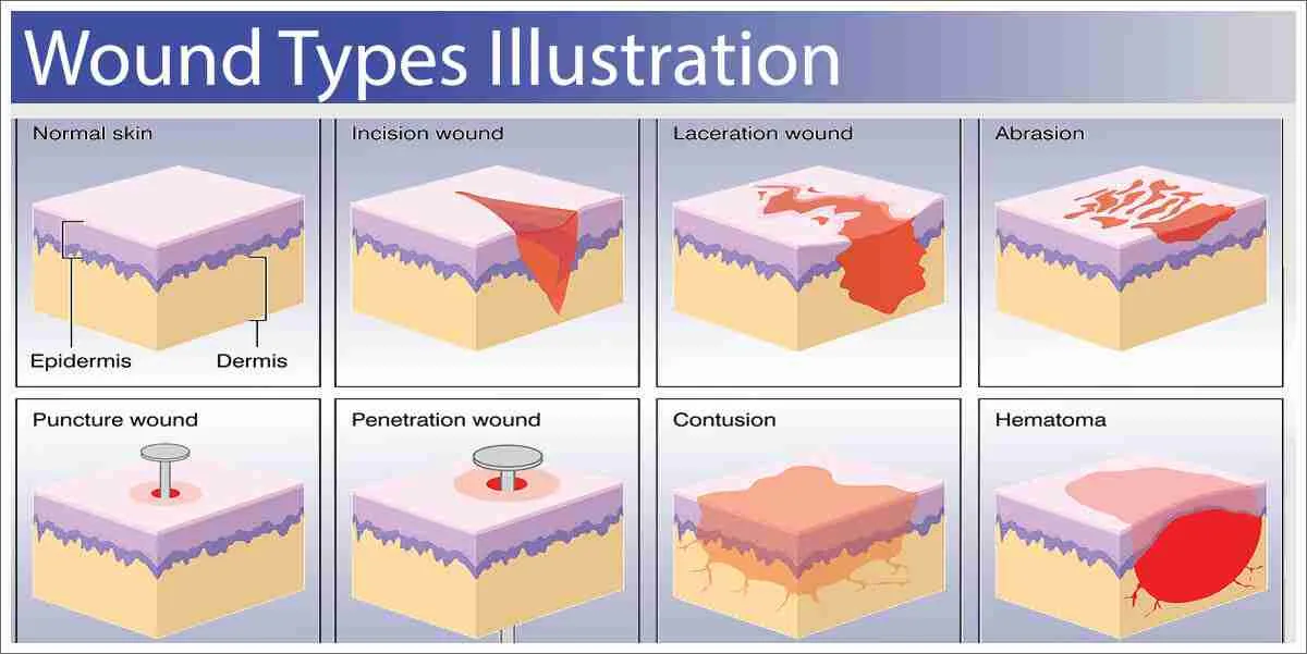 Wound classification model