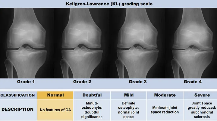 Knee Osteoarthritis Classification