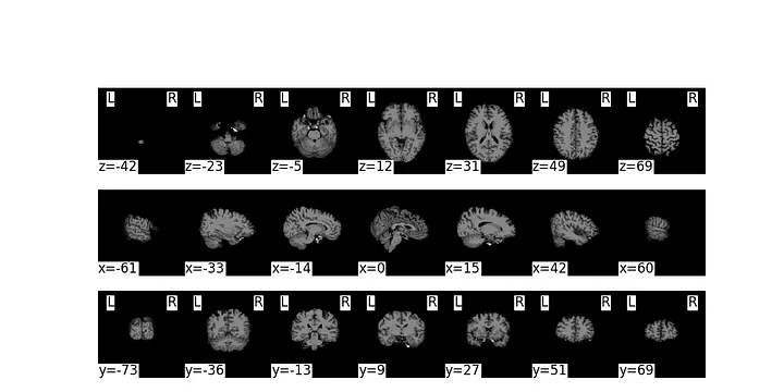 Preclinical Alzhemer Prediction Model