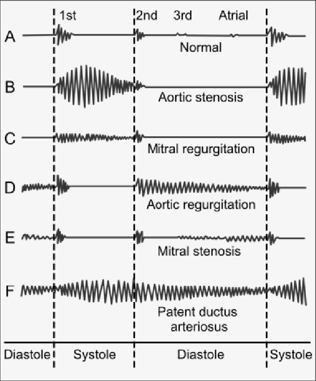 Binary Classification Of Heart Valve Regurgitation.Git